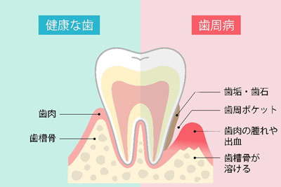 歯石を取るときの出血03