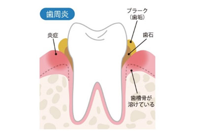 歯石を取るときの出血08